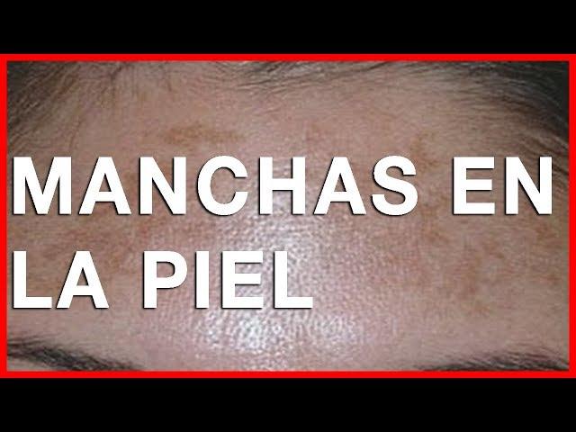 ¿Cómo quitar las manchas de sol en la cara y manos?