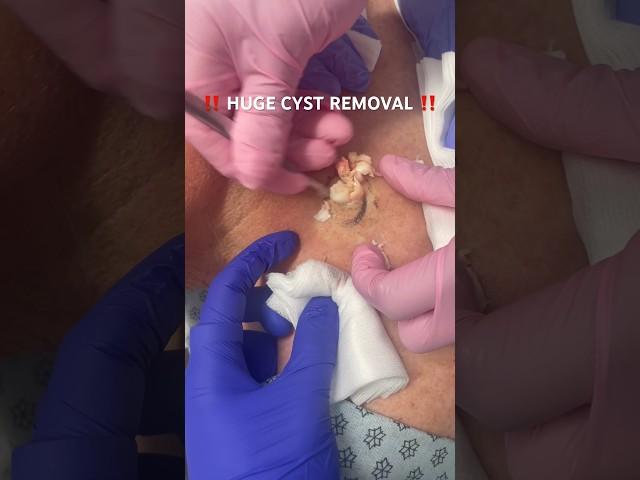 EPIC cyst removal!  #cystpoping #extraction #oddlysatisfying #satisfying #pop