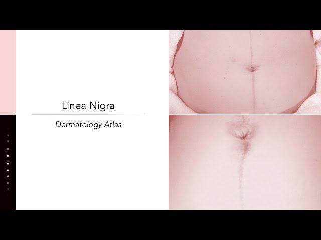 Linea nigra