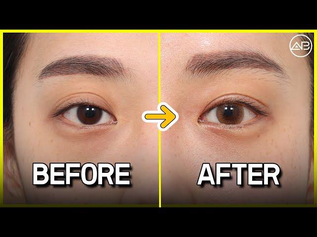 revision double eyelid surgery review | Before & After | AB Plastic Surgery Korea