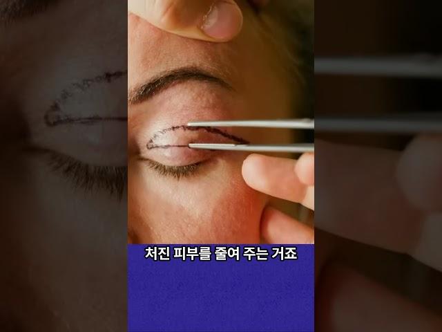 처진눈 수술 후 화가 나 보이는 이유? - 제이제이성형외과 #shorts