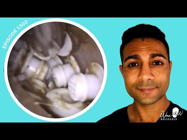 1,503 - TOP 10 MOST BIZARRE FOREIGN BODY EAR EXTRACTIONS! 🫣