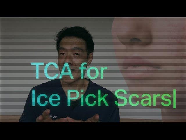 Treatments for Ice pick acne scars | Dr Davin Lim