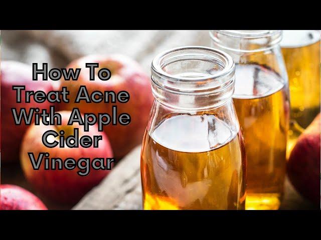 How To Treat Acne With Apple Cider Vinegar | Natural Health Zone