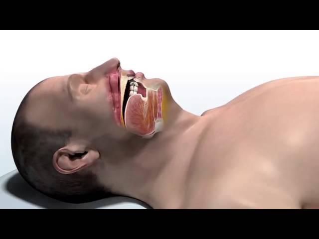 Inspire Therapy for Obstructive Sleep Apnea