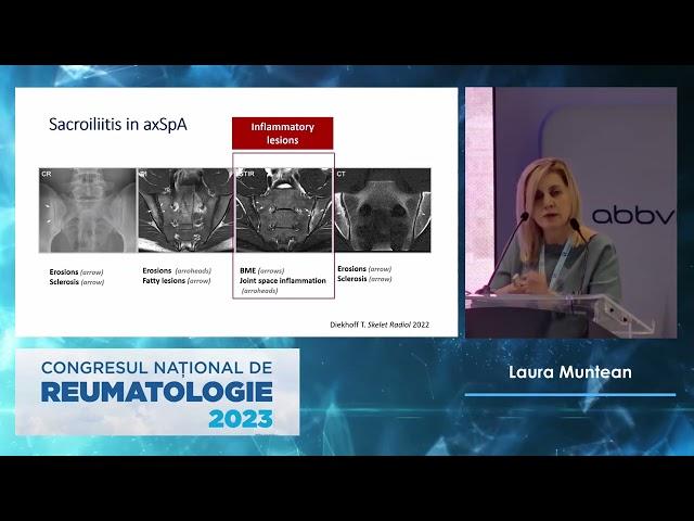 CNR2023 - 05.10 - Laura MUNTEAN -Rolul IRM in diagnisticul si managementul pacientilor cu SpA axiala