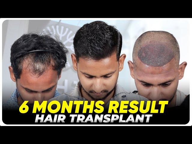 Hair Transplant in Chennai | Best Results & Cost of Hair Transplant in Chennai