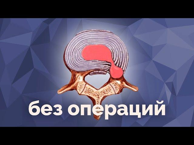 Удаление грыжи без операций. Примеры. Метод модулируемой резорбции