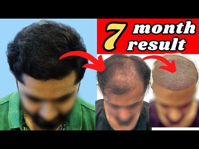 UNBELIEVABLE TRANSFORMATION: 7 MONTH HAIR TRANSPLANT RESULT  #hairtransplant