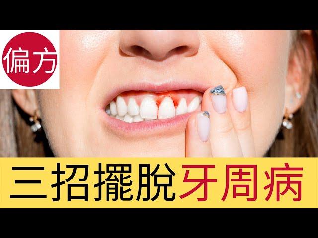 三招解決牙周病｜牙齦發炎，流牙血問題