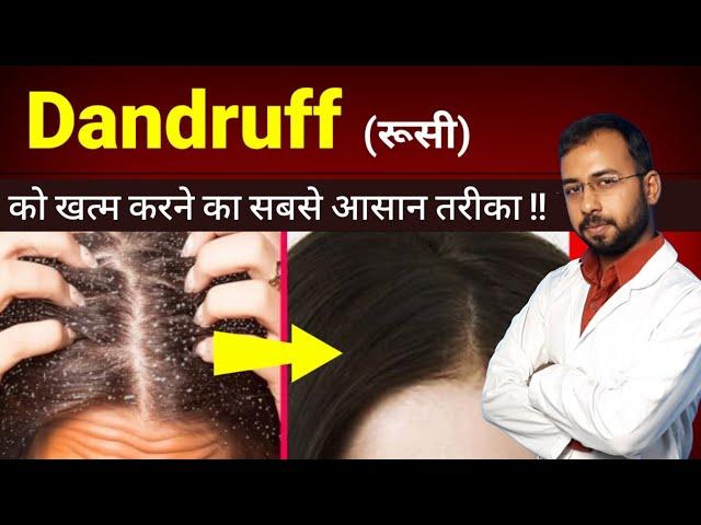 Dandruff ( रुसी ) खत्म करने का सबसे आसान तरीका | dandruff treatment at home | cause of hairfall