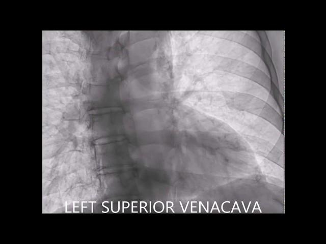 BILATERAL SUPERIOR VENACAVA