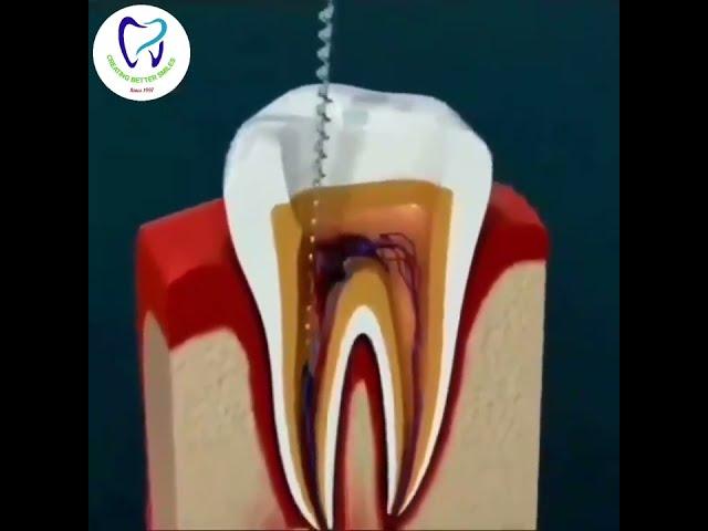 Root Canal Treatment Step by Step Animation