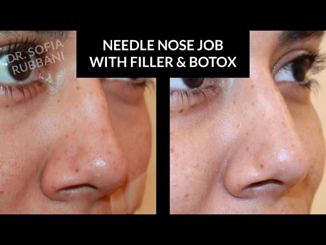 BEFORE & AFTER - Needle Nose Job (After 3 Sessions) by Dr. Rubbani