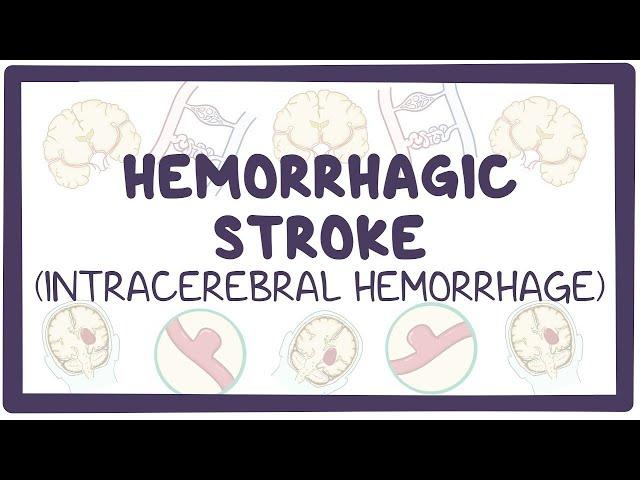 Hemorrhagic stroke: intracerebral hemorrhage - causes, symptoms, diagnosis, treatment, pathology