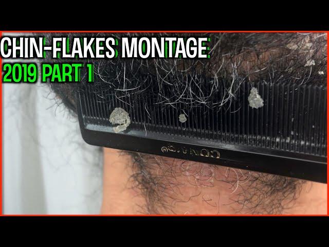 BEARD / CHIN FLAKES MONTAGE 2019 part 1 | DANDRUFF FLAKES | SEBORRHEIC DERMATITIS | PitaFlakes