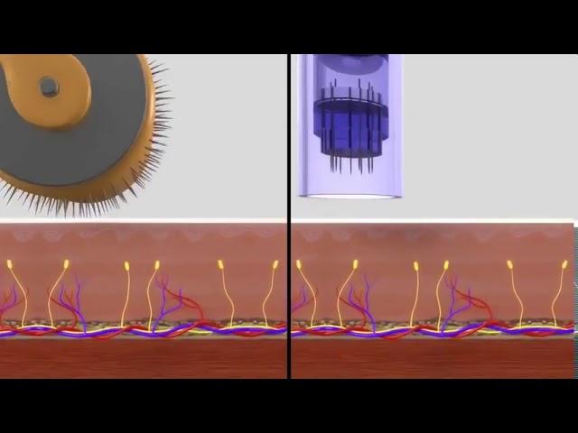 Dermapen v Dermaroller