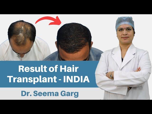 Hair Transplant in India | Delhi Hair Transplant Clinic | Dr. Seema Garg