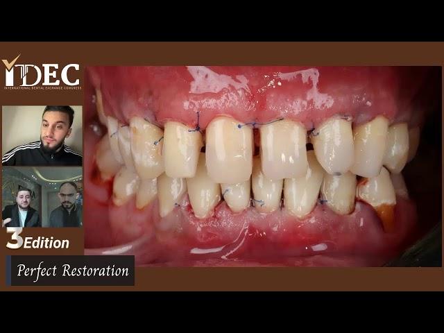 محاضرة قوية  The way to perfect restorations   د أحمد ماهر    د عمار قاسم