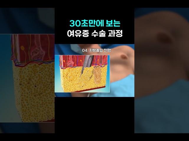 30초만에 보는 여유증 수술 과정 #여유증 #남자 #수술