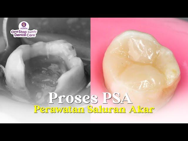 PROSES PSA PERAWATAN SALURAN AKAR l Memperbaiki Gigi Berlubang Parah