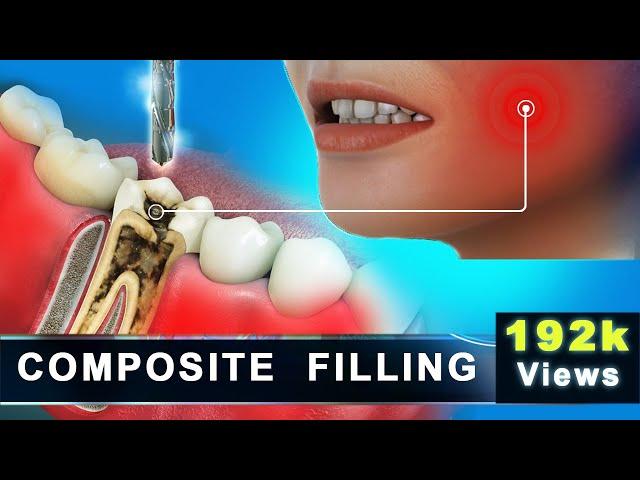 Composite Filling | Molar Cavity Filling with Composite | Advance 3D Dental Animation