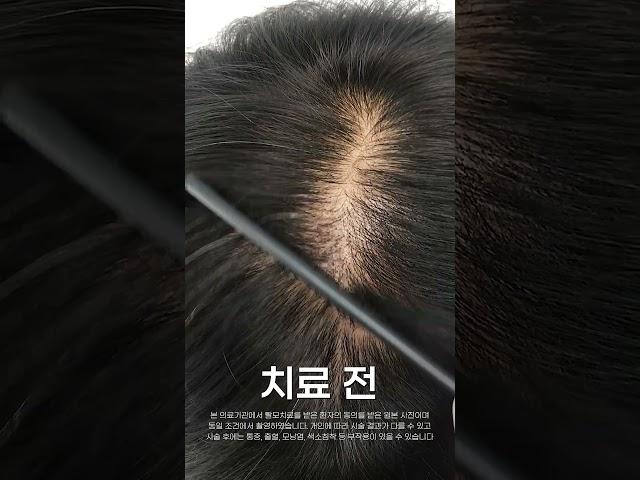 30대 정수리탈모 주사치료 12회 전후