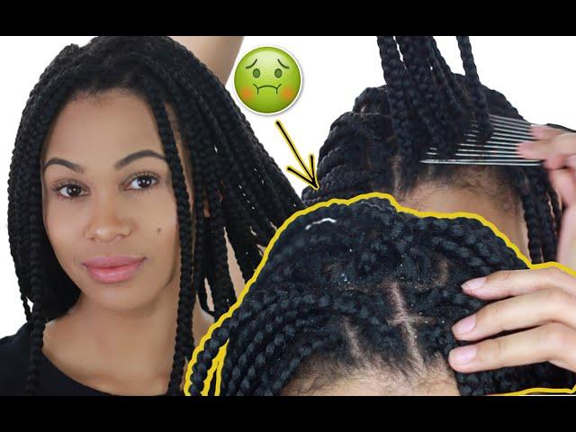 HOW TO CLEAN BOX BRAIDS | REMOVE ALL DANDRUFF & BUILD-UP