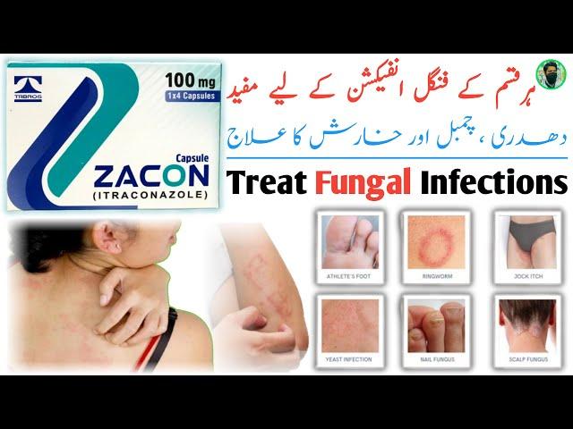 Zacon 100 mg capsule uses | Zacon capsule | itraconazole Capsules 100mg Uses | Fungal Infection ...