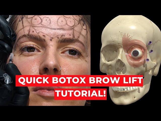 3D Botox BROW LIFT INJECTION TUTORIAL