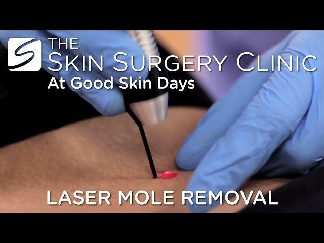 Laser Mole Removal | Watch the Procedure