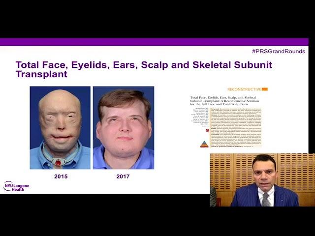 #PRSGrandRounds: Face Transplantation - Current State & Future Directions