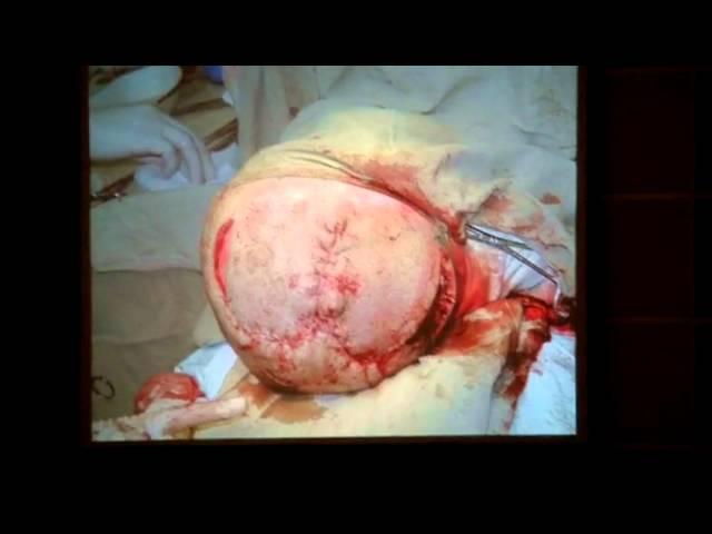 Neurosurgery treatment of extensive defects of skull