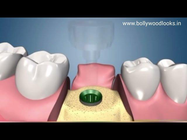 Dental Implants (Step by Step Procedure)