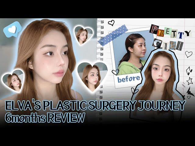 Dramatic Results with Just 2 Surgeries(KOREA PLASTIC SURGRGERY TRANSFORMATION)