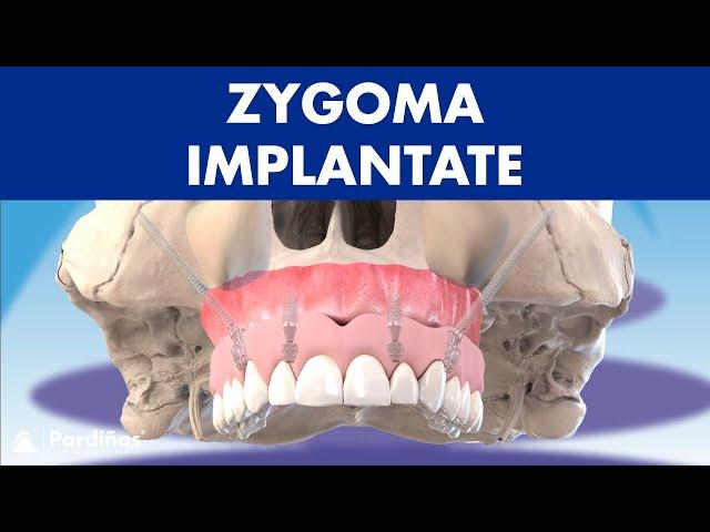 ZYGOMA-Implantate - Behandlung ohne Knochenaufbau ©