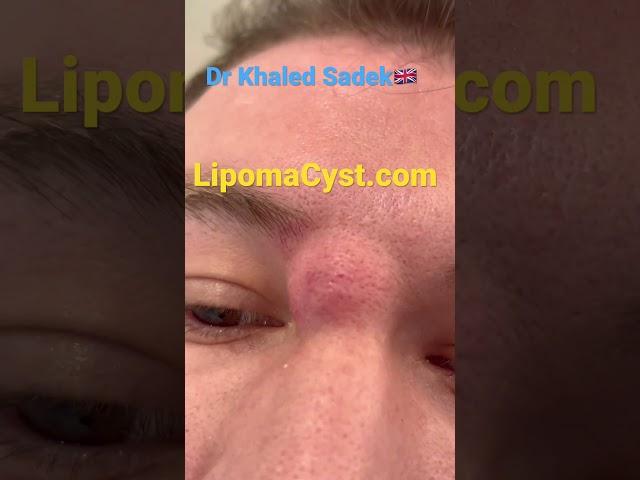 Massive face cyst removal Dr Khaled Sadek #acne #blackheadremoval #skinadvice LIPOMACYST clinic