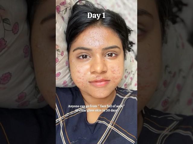 Anyone can go from "Face full of acne" to "clear glass skin" in 30 days #shorts #skincare #acne