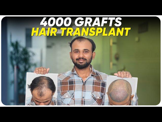 Hair Transplant in Bhopal | Best Results & Cost of Hair Transplant in Bhopal