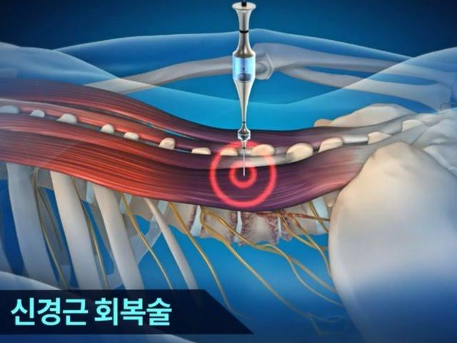 허리디스크 자생한방병원 치료법-효과 빠른 신경근회복술