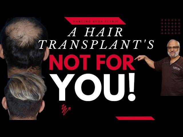 This Hair Transplant Result in India might not be yours | Howto get a great Hair Transplant in India