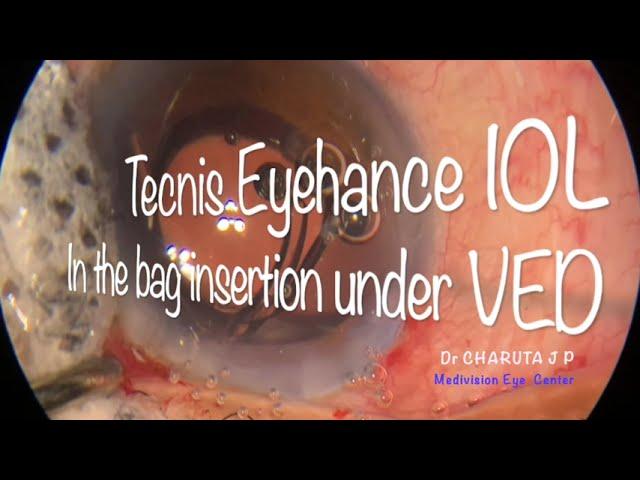 Topical Phacoemulsification on Centurian Vision System with Active Sentry