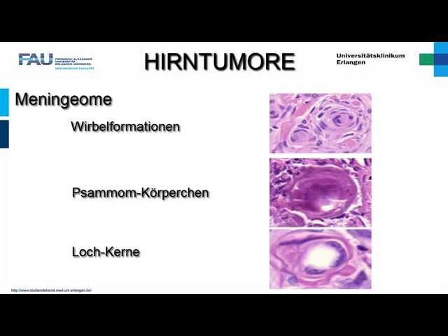 Neuropathologie ─ Hirntumoren