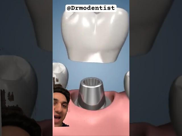 How A Dental implant Tooth  Attaches To the Dental implant! #dentalimplantprocedure #implantdenture