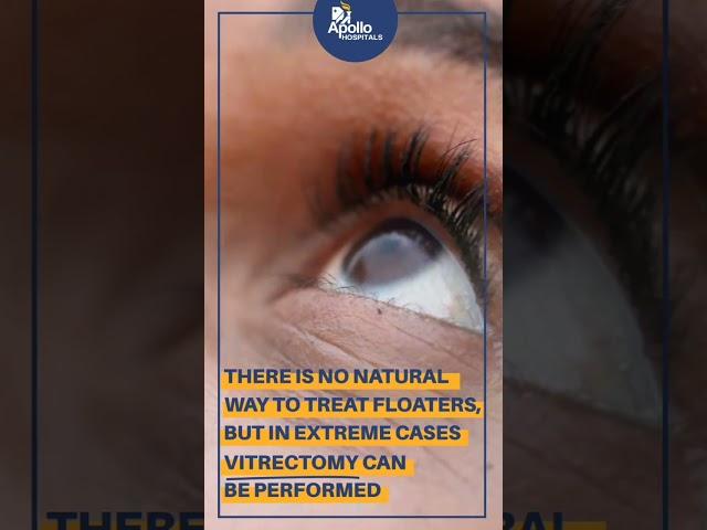 How to reduce floaters in the eyes? | Apollo Hospitals