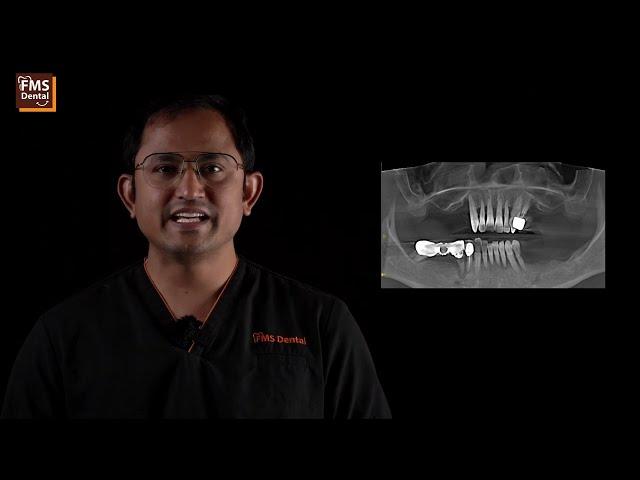 All on 4 Dental Implants | Zygoma Dental Implants for no bone | FMS Dental