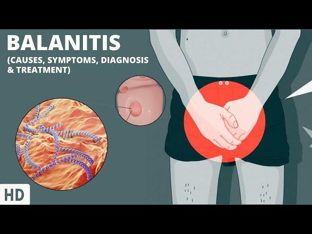 The Secrets to Breaking Free from Balanitis: Your Complete Guide to Understanding and Treatment!