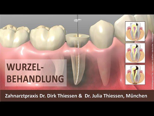 Wurzelbehandlung Zahnarzt München-Neuperlach - Dr. Dirk Thiessen & Dr. Julia Thiessen