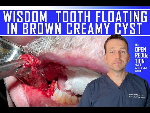 WISDOM TOOTH in BROWN CREAMY CYST