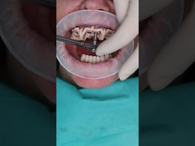 Dental implant’s All on 4 in Prague #shorts #dentist #dental #implant #veneers #short
